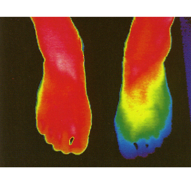   足部健康評(píng)估：

熱成像可以用來(lái)監(jiān)測(cè)糖尿病患者的足部溫度，預(yù)防足部并發(fā)癥，如潰瘍和感染。